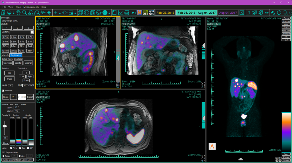 Screen capture of fused PET/MR series displayed in UniSyn MI.