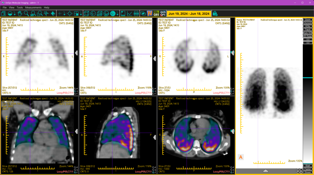 Screen capture of fused lung perfusion SPECT/CT series displayed with UniSyn MI.