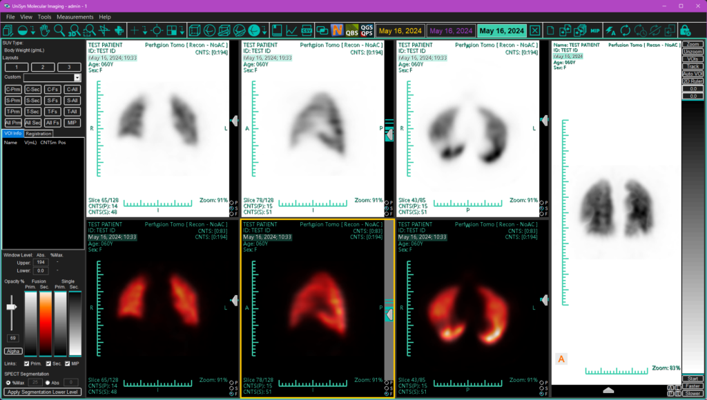 Screen capture of fused lung V/Q SPECT series displayed in UniSyn MI.